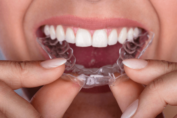 How Does Invisalign Work? | The Emergency Dentist Phoenix