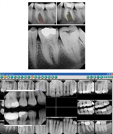 Digital X-Rays | The Emergency Dentist Phoenix