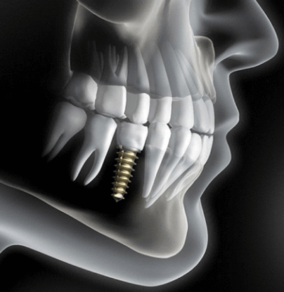 Reasons For Dental Implants | The Emergency Dentist Phoenix