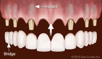 Implant-Supported Fixed Bridgework | The Emergency Dentist Phoenix