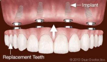 Implant-Supported Fixed Dentures | The Emergency Dentist Phoenix