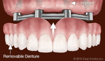 Implant-Supported Removable Dentures | The Emergency Dentist Phoenix