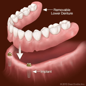 Implant-Supported Removable Dentures | The Emergency Dentist Phoenix