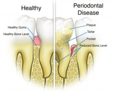 What Is Periodontal Disease? | The Emergency Dentist Phoenix